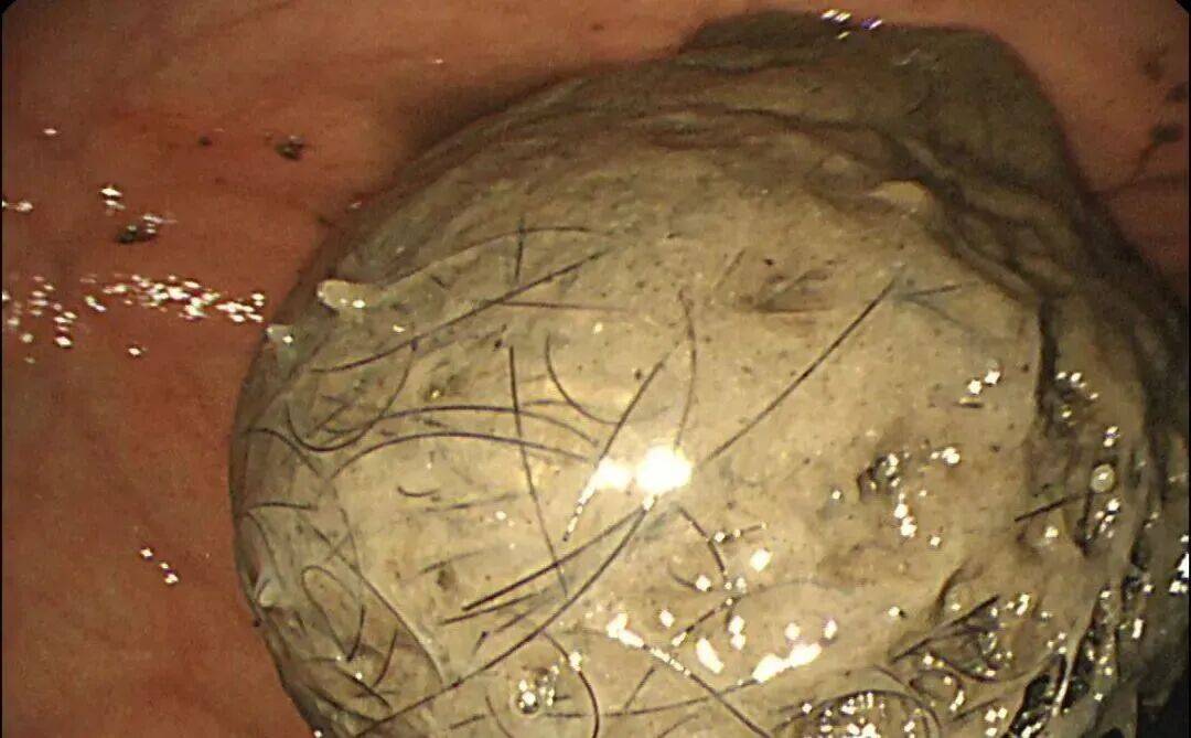 皇冠信用網在线注册_发现一例皇冠信用網在线注册,10岁女孩确诊!已有多起病例,有人因羞耻感延误就医