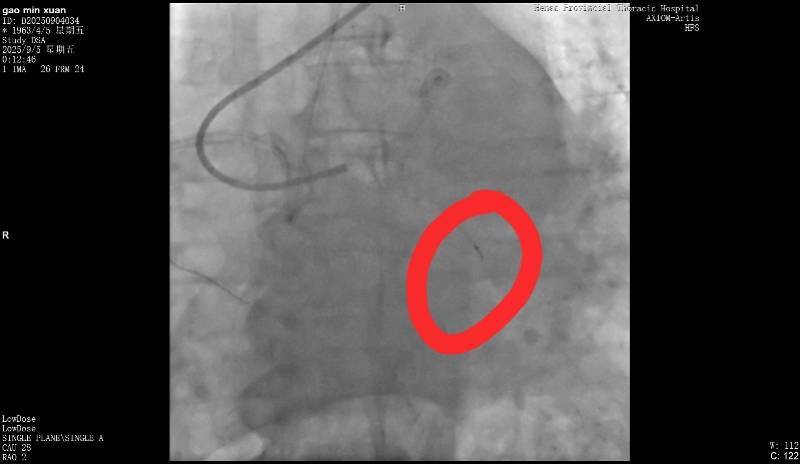皇冠信用网在线注册_河南一老人做冠脉造影手术时一截导丝断在血管中皇冠信用网在线注册!院方回应