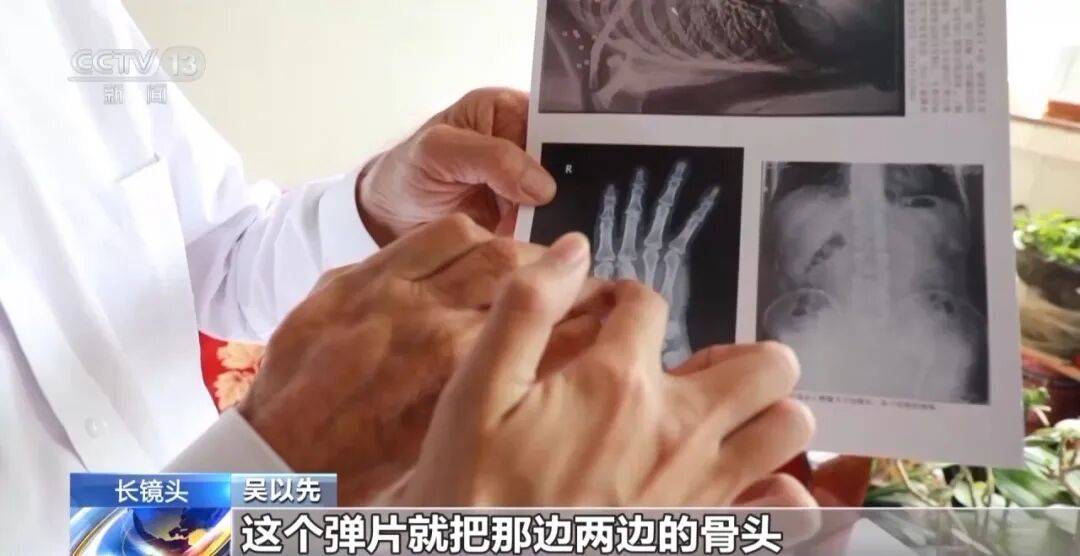 皇冠信用怎么弄
_“老先生皇冠信用怎么弄
,您把项链取下来再做CT”“你看是不是弹片”